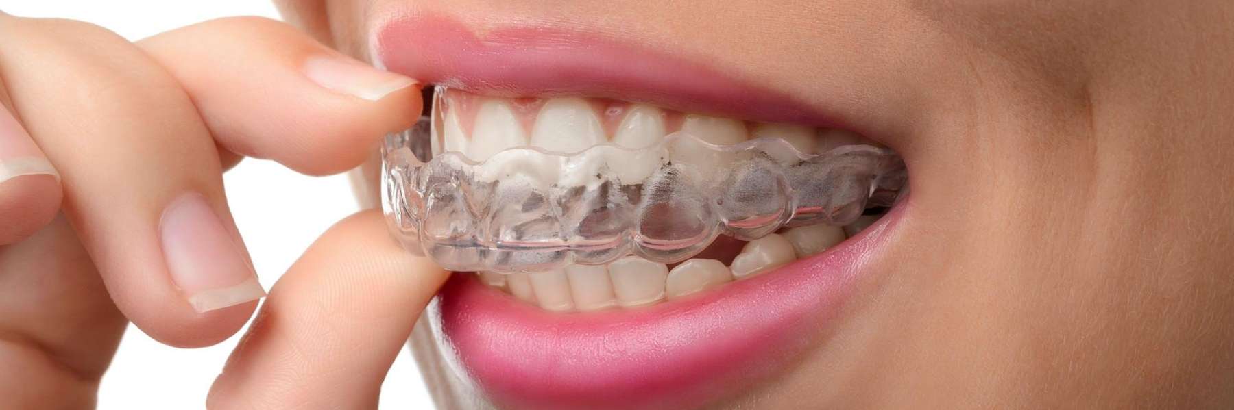 Woman smiling with clear braces, illustrating early signs you might need orthodontic treatment