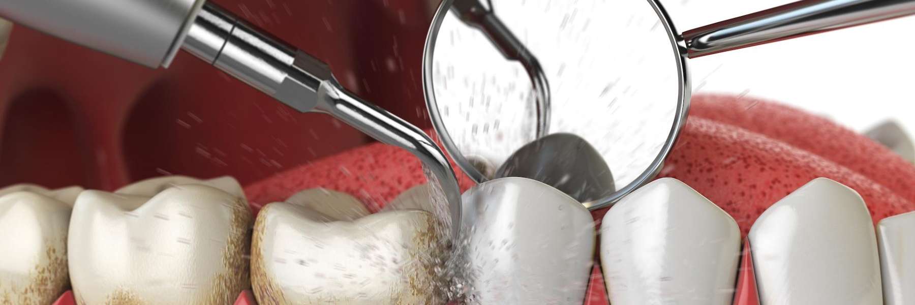 Dental cleaning molar tartar in Northborough MA