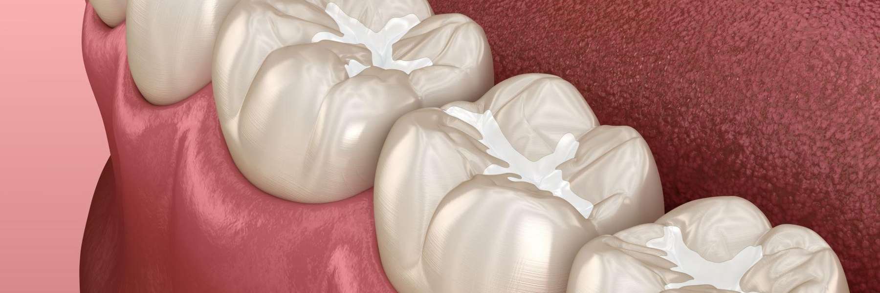 White filling of molar teeth in Northborough MA
