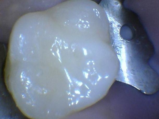 A sealed cavity at Children's Dentistry of Northborough