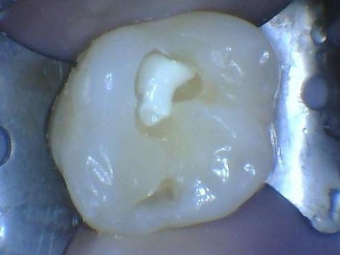 The linear placed inside a cavity at Children's Dentistry of Northborough