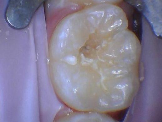 The beginning of a cavity removal at Children's Dentistry of Northborough in Northborough, MA