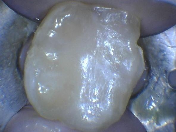 A filled cavity after composite is place at Children's Dentistry
