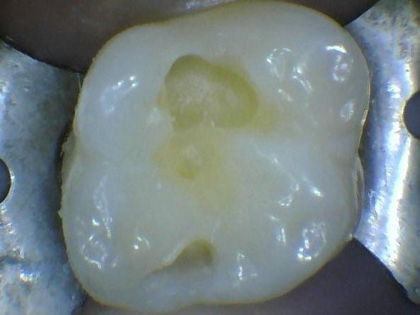 A cavity removed | Children's Dentistry of Northborough MA