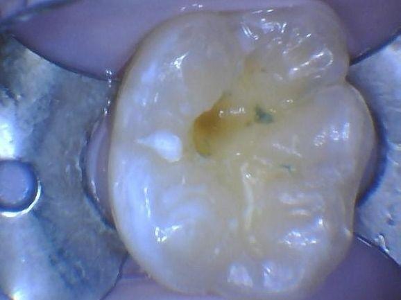 Dye used during a cavity removal at Children's Dentistry of Northborough in Northborough, MA