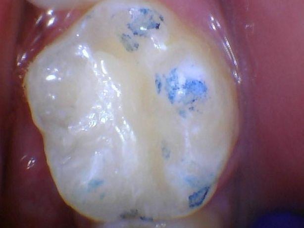 After a cavity is filled and sealed at Children's Dentistry of Northborough